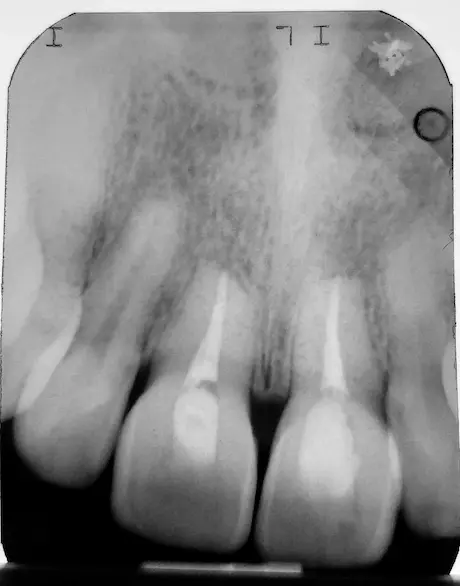 Endodoncia